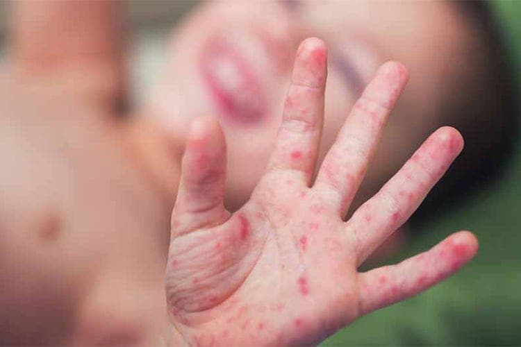 انتشار فيروس الحصبة بشكل حاد في المغرب: مطالب عاجلة بإعلان حالة طوارئ صحية